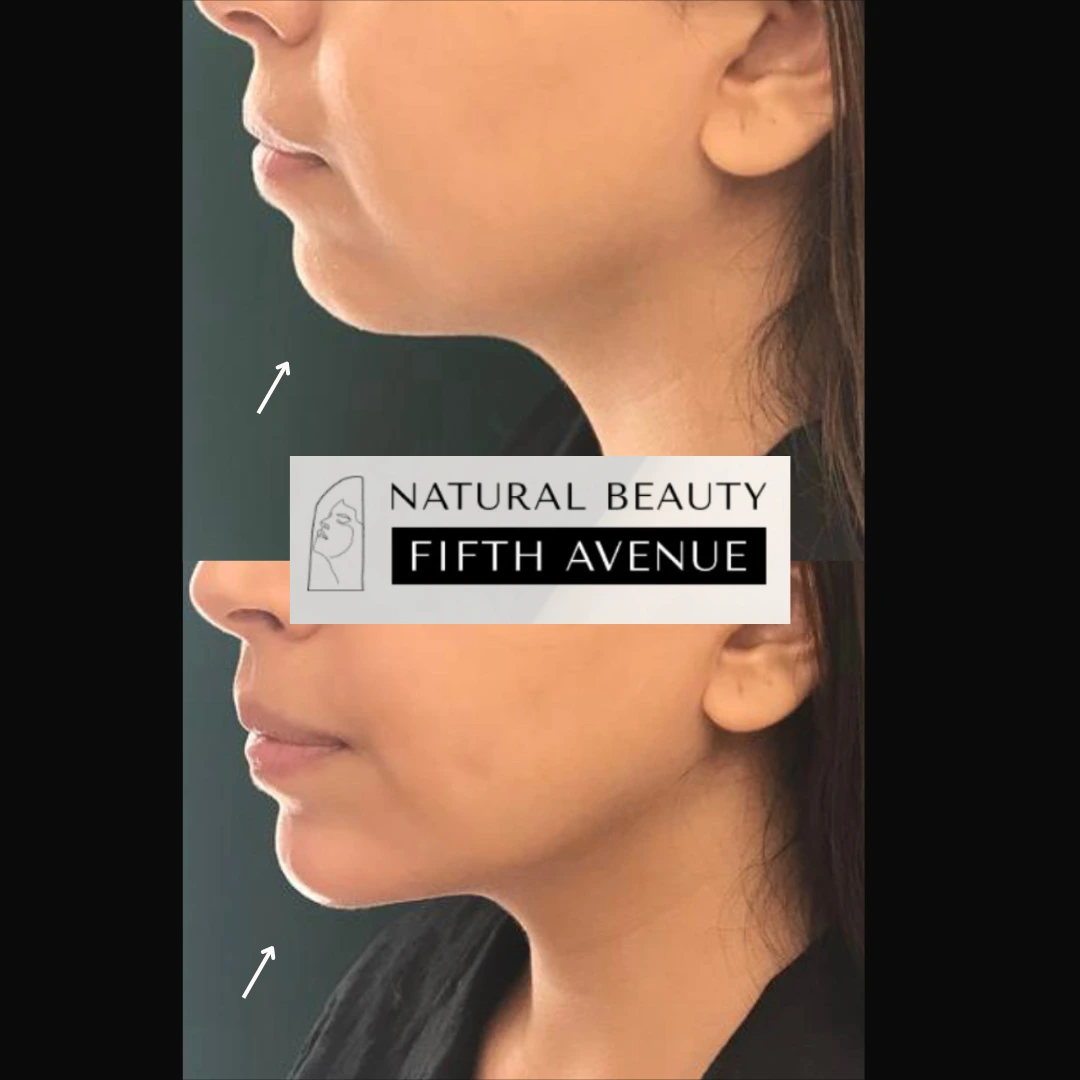 Side profile of a woman's face and neck with arrows pointing to jawline, showing before and after results of aesthetic treatment at Natural Beauty Fifth Avenue
